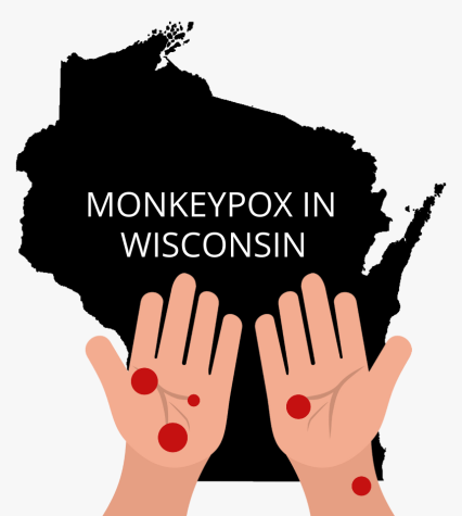 What you need to know about monkeypox